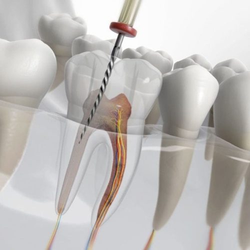 Kanal-Tedavisi-1024x683-1